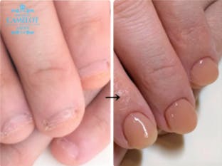 深爪矯正ネイルのビフォーアフター