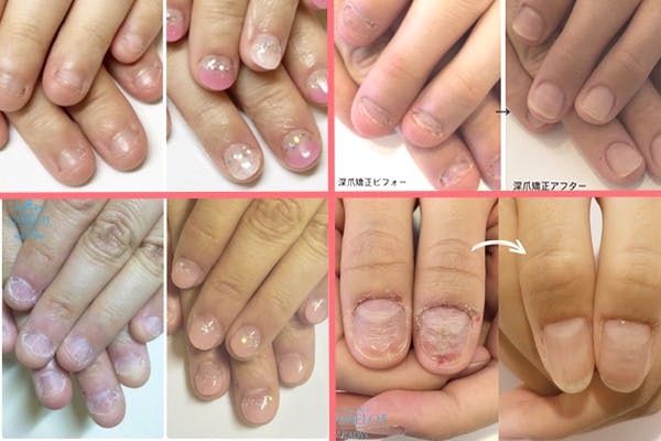 深爪矯正ネイルのビフォーアフター